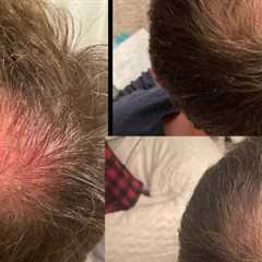 Hair Growth Injections Ardmore, PA