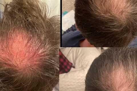 Hair Growth Injections Ardmore, PA